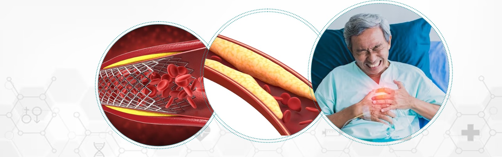 Symptoms of Blocked Artery: Its Causes, Symptoms & Treatment