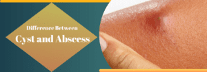 Difference Between Cyst and Abscess