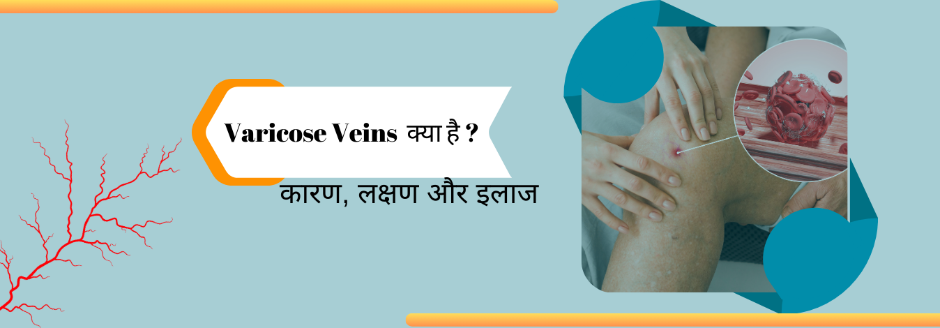 Varicose Veins  क्या है ?